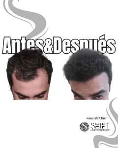 Antes y después de un trasplante capilar para la calvicie de Norwood 3 en Turquía en SHIFT Hair en Estambul 01 3