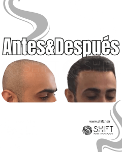 Antes y después de un trasplante capilar para la calvicie de Norwood 3 en Turquía en SHIFT Hair en Estambul 02 3