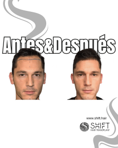 Antes y después de un trasplante capilar para la calvicie de Norwood 3 en Turquía en SHIFT Hair en Estambul 04 3