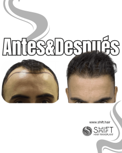 Antes y después de un trasplante capilar para la calvicie de Norwood 3 en Turquía en SHIFT Hair en Estambul 05 3