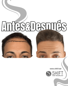 Antes y después de un trasplante capilar para la calvicie de Norwood 3 en Turquía en SHIFT Hair en Estambul 06 3