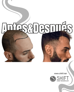 Antes y después de un trasplante capilar para la calvicie de Norwood 3 en Turquía en SHIFT Hair en Estambul 07 3