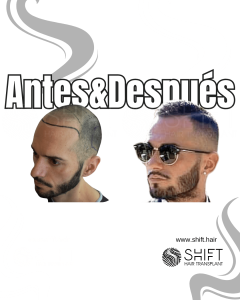 Antes y después de un trasplante capilar para la calvicie de Norwood 3 en Turquía en SHIFT Hair en Estambul 08 3