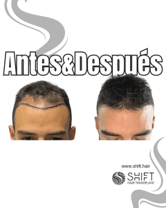 Antes y después de un trasplante capilar para la calvicie de Norwood 3 en Turquía en SHIFT Hair en Estambul 11 3