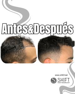 Antes y después de un trasplante capilar para la calvicie de Norwood 3 en Turquía en SHIFT Hair en Estambul 12 3