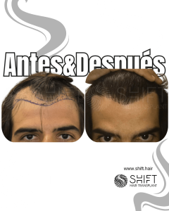Antes y después de un trasplante capilar para la calvicie de Norwood 3 en Turquía en SHIFT Hair en Estambul 13 3