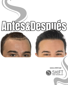 Antes y después de un trasplante capilar para la calvicie de Norwood 3 en Turquía en SHIFT Hair en Estambul 14 3