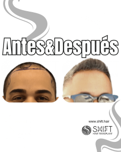 Antes y después de un trasplante capilar para la calvicie de Norwood 3 en Turquía en SHIFT Hair en Estambul 16 3