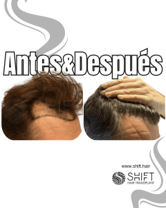 Antes y después de un trasplante capilar para la calvicie de Norwood 3 en Turquía en SHIFT Hair en Estambul 18 3