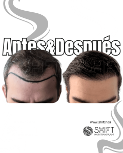 Antes y después de un trasplante capilar para la calvicie de Norwood 3 en Turquía en SHIFT Hair en Estambul 19 3