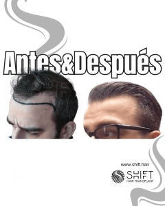 Antes y después de un trasplante capilar para la calvicie de Norwood 3 en Turquía en SHIFT Hair en Estambul 20 3