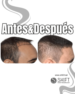 Antes y después de un trasplante capilar para la calvicie de Norwood 3 en Turquía en SHIFT Hair en Estambul 21 3