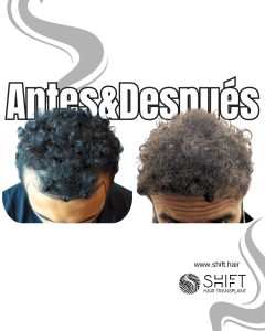 Antes y después de un trasplante capilar para la calvicie de Norwood 3 en Turquía en SHIFT Hair en Estambul 23 3