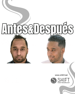 Antes y después de un trasplante capilar para la calvicie de Norwood 3 en Turquía en SHIFT Hair en Estambul 24 3