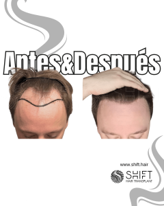 Antes y después de un trasplante capilar para la calvicie de Norwood 3 en Turquía en SHIFT Hair en Estambul 25 3