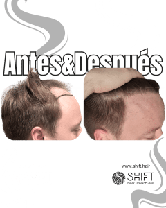 Antes y después de un trasplante capilar para la calvicie de Norwood 3 en Turquía en SHIFT Hair en Estambul 26 3