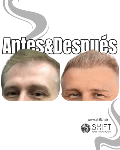 Antes y después de un trasplante capilar para la calvicie de Norwood 3 en Turquía en SHIFT Hair en Estambul 27 3