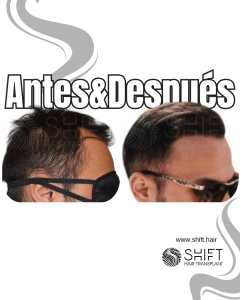 Antes y después de un trasplante capilar para la calvicie de Norwood 3 en Turquía en SHIFT Hair en Estambul 29 3