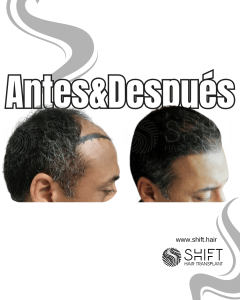 Antes y después de un trasplante capilar para la calvicie de Norwood 4 en Turquía en SHIFT Hair en Estambul 02 3