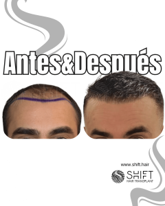 Antes y después de un trasplante capilar para la calvicie de Norwood 4 en Turquía en SHIFT Hair en Estambul 03 3