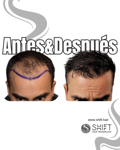 Antes y después de un trasplante capilar para la calvicie de Norwood 4 en Turquía en SHIFT Hair en Estambul 04 3