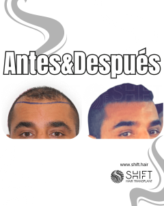 Antes y después de un trasplante capilar para la calvicie de Norwood 4 en Turquía en SHIFT Hair en Estambul 05 3