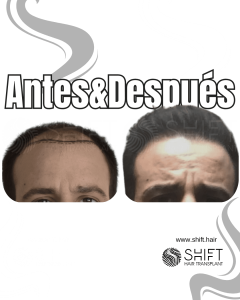 Antes y después de un trasplante capilar para la calvicie de Norwood 4 en Turquía en SHIFT Hair en Estambul 06 3