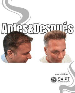 Antes y después de un trasplante capilar para la calvicie de Norwood 4 en Turquía en SHIFT Hair en Estambul 10 3