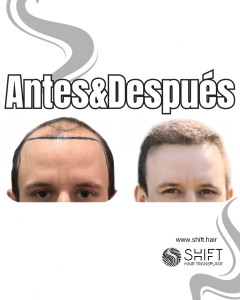 Antes y después de un trasplante capilar para la calvicie de Norwood 4 en Turquía en SHIFT Hair en Estambul 13 3