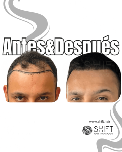 Antes y después de un trasplante capilar para la calvicie de Norwood 4 en Turquía en SHIFT Hair en Estambul 14 3