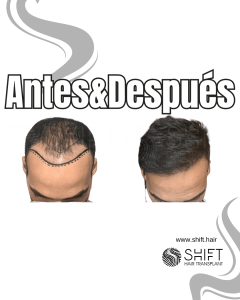 Antes y después de un trasplante capilar para la calvicie de Norwood 4 en Turquía en SHIFT Hair en Estambul 15 3