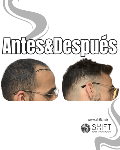 Antes y después de un trasplante capilar para la calvicie de Norwood 4 en Turquía en SHIFT Hair en Estambul 16 3