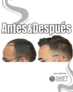 Antes y después de un trasplante capilar para la calvicie de Norwood 4 en Turquía en SHIFT Hair en Estambul 17 3