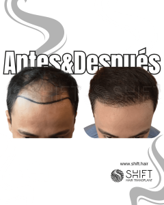Antes y después de un trasplante capilar para la calvicie de Norwood 4 en Turquía en SHIFT Hair en Estambul 20 3