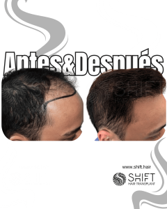 Antes y después de un trasplante capilar para la calvicie de Norwood 4 en Turquía en SHIFT Hair en Estambul 21 3