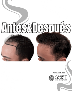 Antes y después de un trasplante capilar para la calvicie de Norwood 4 en Turquía en SHIFT Hair en Estambul 22 3