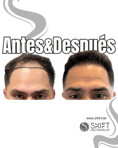 Antes y después de un trasplante capilar para la calvicie de Norwood 4 en Turquía en SHIFT Hair en Estambul 23 3