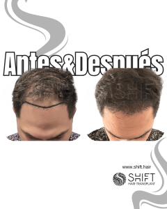 Antes y después de un trasplante capilar para la calvicie de Norwood 4 en Turquía en SHIFT Hair en Estambul 24 3