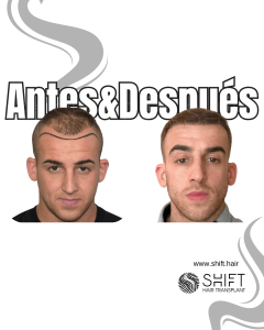 Antes y después de un trasplante capilar para la calvicie de Norwood 4 en Turquía en SHIFT Hair en Estambul 25 3