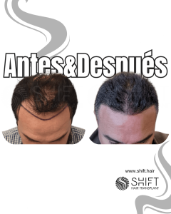 Antes y después de un trasplante capilar para la calvicie de Norwood 5 en Turquía en SHIFT Hair en Estambul 01 3