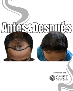 Antes y después de un trasplante capilar para la calvicie de Norwood 5 en Turquía en SHIFT Hair en Estambul 02 3