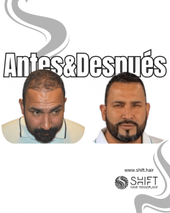 Antes y después de un trasplante capilar para la calvicie de Norwood 5 en Turquía en SHIFT Hair en Estambul 04 3