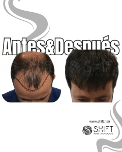 Antes y después de un trasplante capilar para la calvicie de Norwood 5 en Turquía en SHIFT Hair en Estambul 06 3