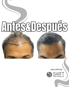 Antes y después de un trasplante capilar para la calvicie de Norwood 5 en Turquía en SHIFT Hair en Estambul 07 3