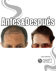 Antes y después de un trasplante capilar para la calvicie de Norwood 5 en Turquía en SHIFT Hair en Estambul 08 3