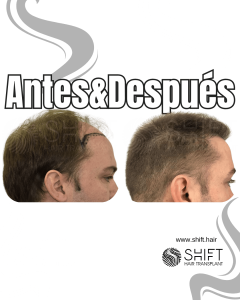 Antes y después de un trasplante capilar para la calvicie de Norwood 5 en Turquía en SHIFT Hair en Estambul 09 3