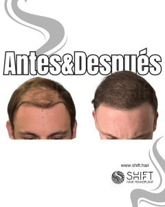 Antes y después de un trasplante capilar para la calvicie de Norwood 5 en Turquía en SHIFT Hair en Estambul 10 3