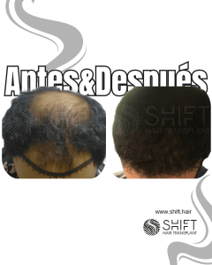 Antes y después de un trasplante capilar para la calvicie de Norwood 5 en Turquía en SHIFT Hair en Estambul 11 3