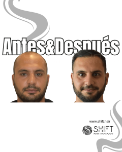 Antes y después de un trasplante capilar para la calvicie de Norwood 5 en Turquía en SHIFT Hair en Estambul 13 3