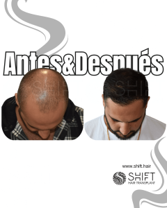 Antes y después de un trasplante capilar para la calvicie de Norwood 5 en Turquía en SHIFT Hair en Estambul 14 3